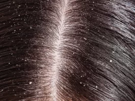 How to Cure Dandruff Permanently