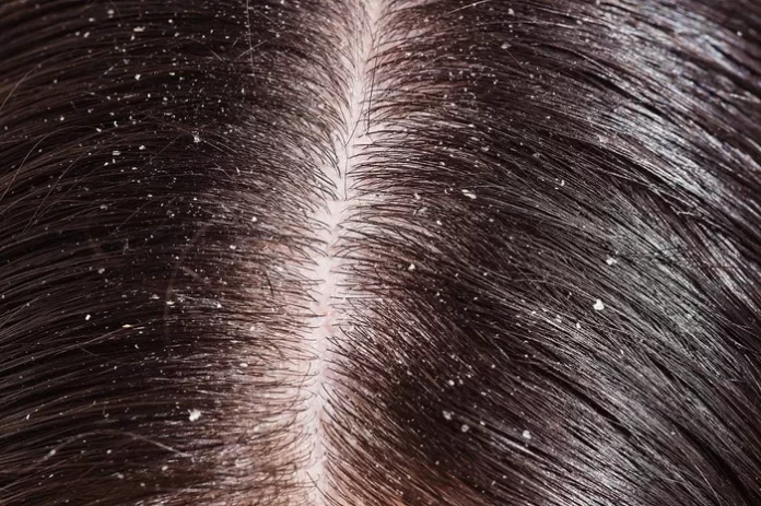 How to Cure Dandruff Permanently